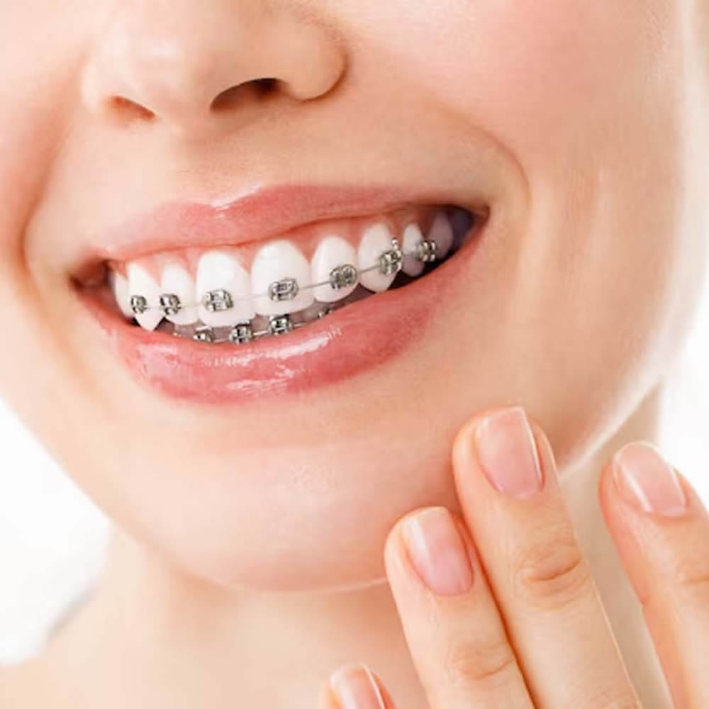 Braces