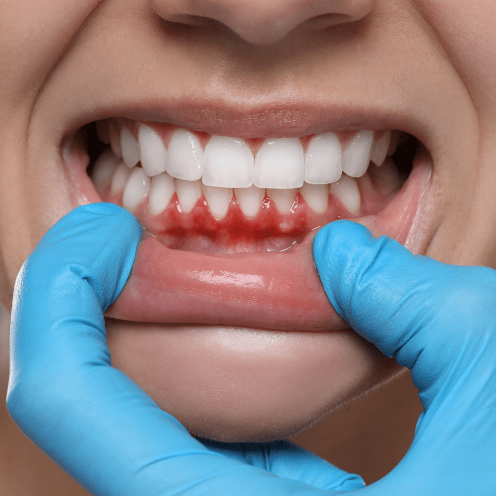 Periodontoloji (Diş Eti Tedavisi)